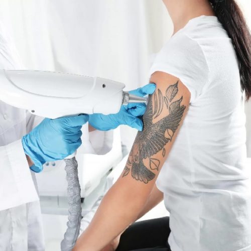 What You Need to Know About Non-surgical Tattoo Removal
