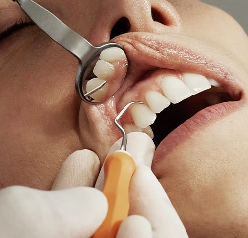 Why Opt For Root Canal Treatment Over Extraction?