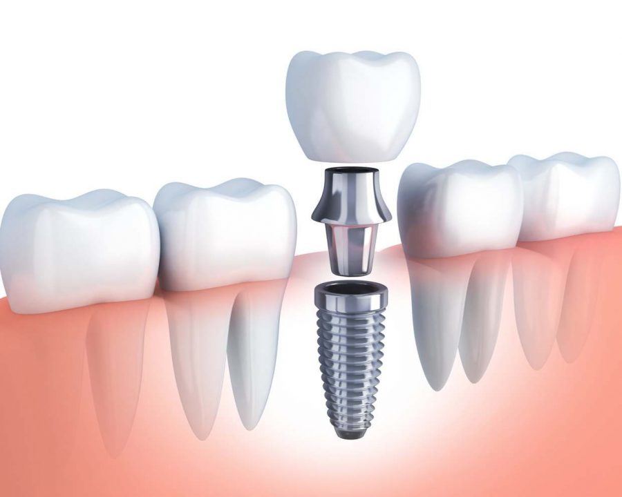 Restore Your Natural Appearance Through Dental Implant