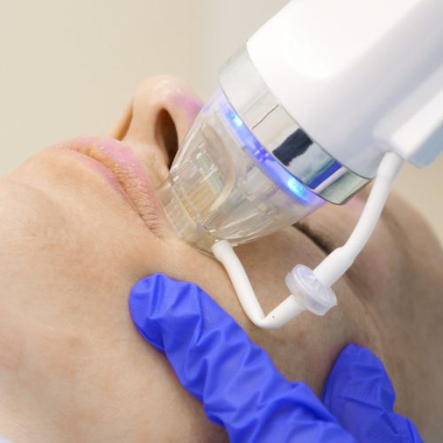 What are the Benefits of RF Microneedling?