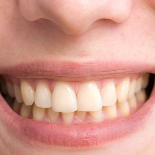 Root Canal Treatment: Saving Your Tooth from the Inside Out