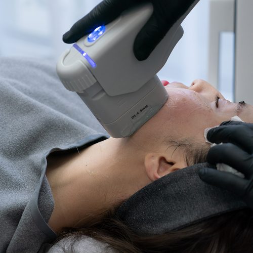 Comparing Chemical Peels, Lasers, and Medical Facials for Acne Scar Removal