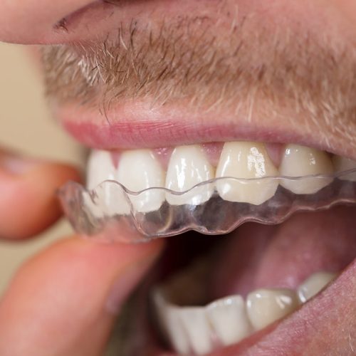 Does Dental Insurance Help Cover Invisalign Costs?