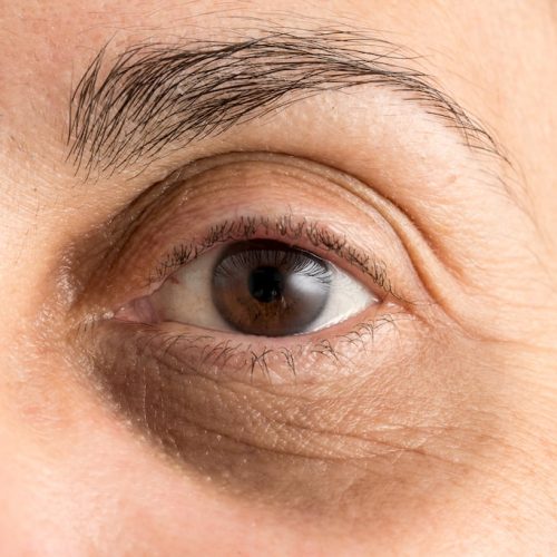 Dark Eye Circles Removal Downtime And Recovery Plan