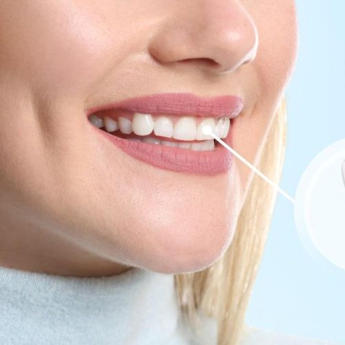 Dental Implant Procedure